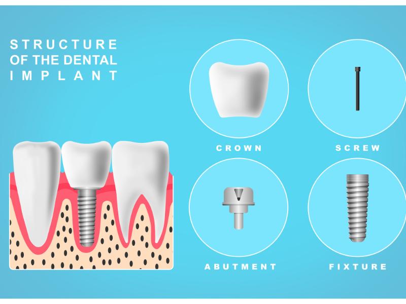 An example of a dental implant structure like we place at our dental office in Watauga, TX